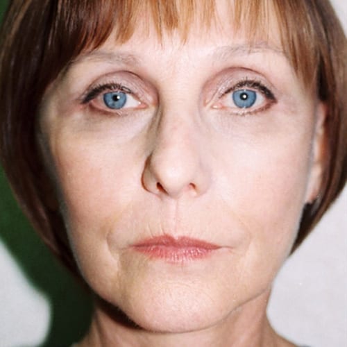 Facelift-12 | After Facelift 2