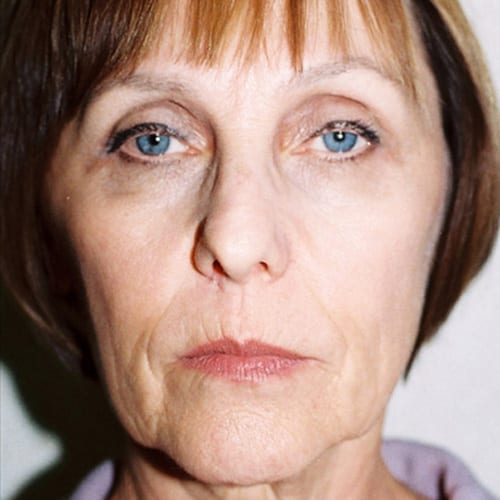 Facelift-12 | Before Facelift 2