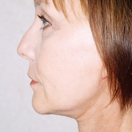 Facelift-12 | After Facelift 3