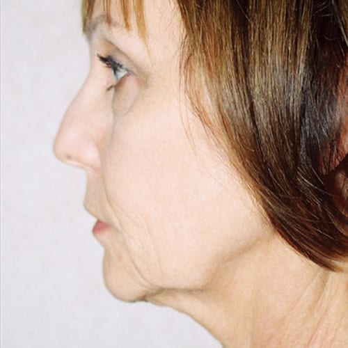 Facelift-12 | Before Facelift 3