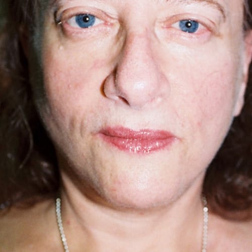 Facelift-13 | After Facelift 2