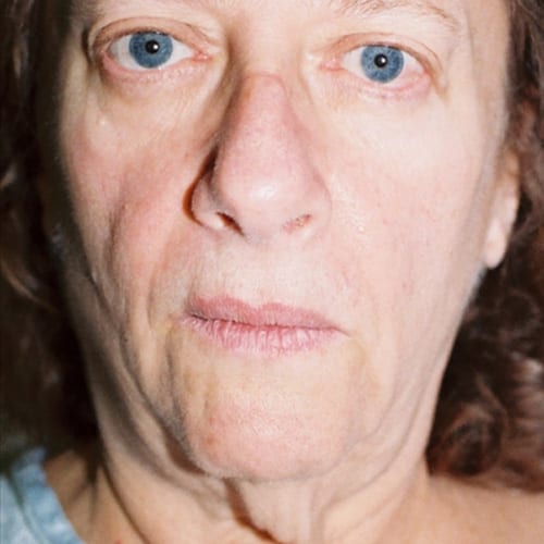 Facelift-13 | Before Facelift 2