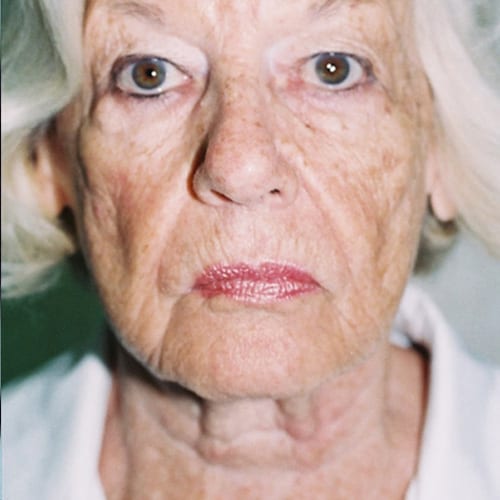 Facelift-15 | Before Facelift 2