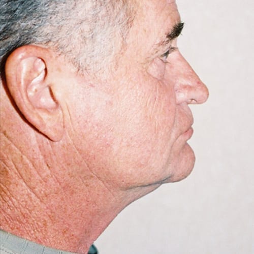 Facelift-16 | Before Facelift