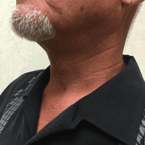 Facelift-18 | After Facelift