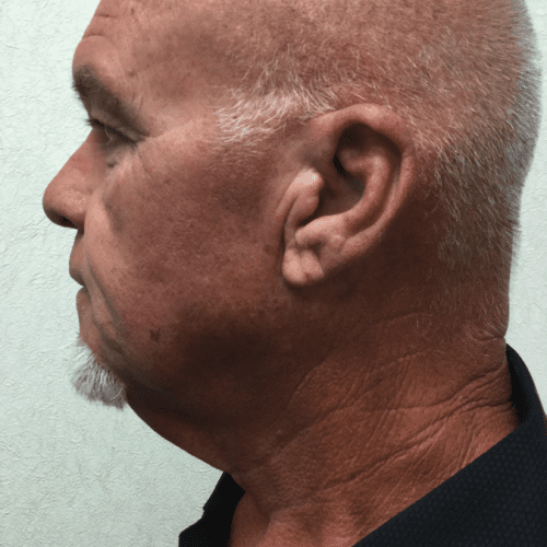 Facelift-18 | Before Facelift