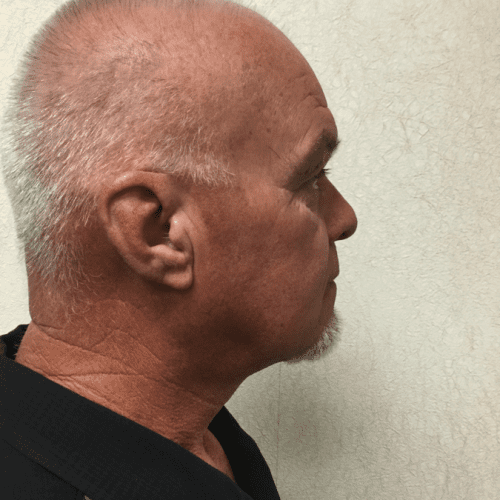 Facelift-18 | After Facelift 3