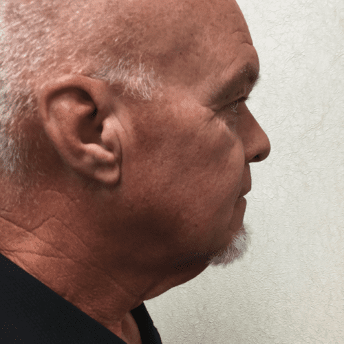 Facelift-18 | Before Facelift 3