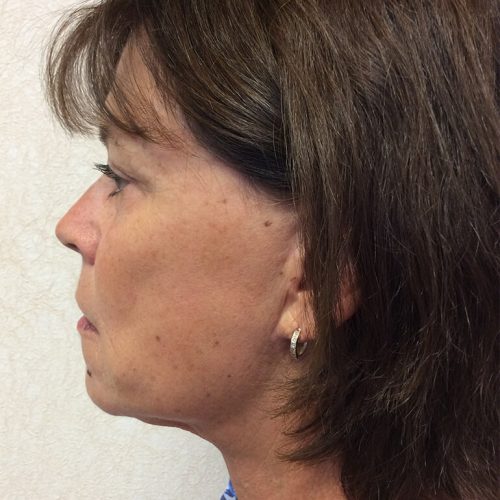 Facelift-19 | After Facelift