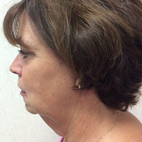 Facelift-19 | Before Facelift