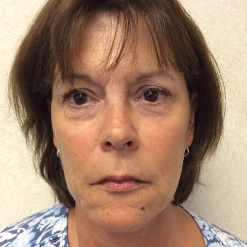 Facelift-19 | After Facelift 2