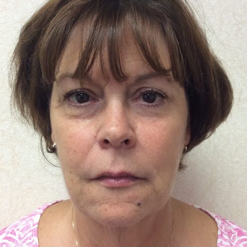 Facelift-19 | Before Facelift 2