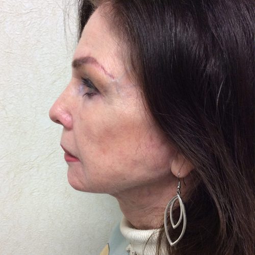 Facelift-20 | After Facelift