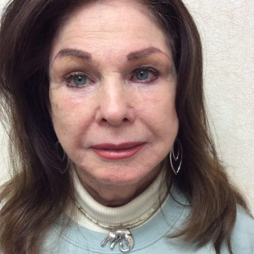 Facelift-20 | After Facelift 2