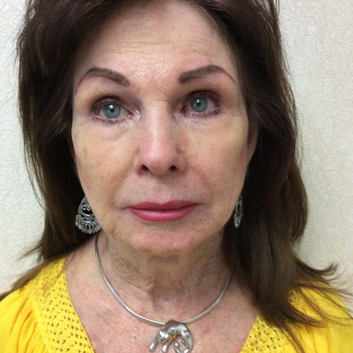 Facelift-20 | Before Facelift 2