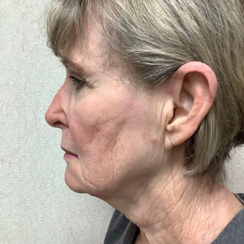 Facelift-21 | Before Facelift