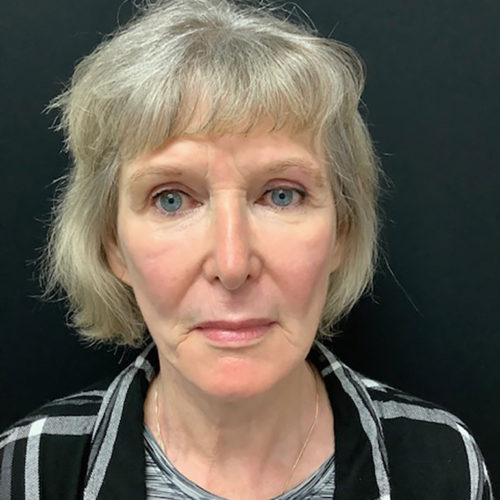 Facelift-21 | After Facelift 2