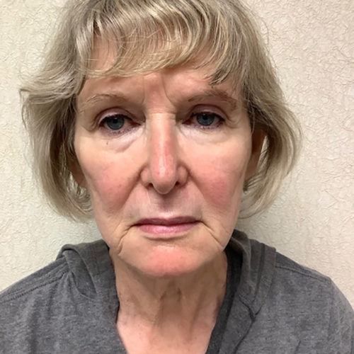 Facelift-21 | Before Facelift 2