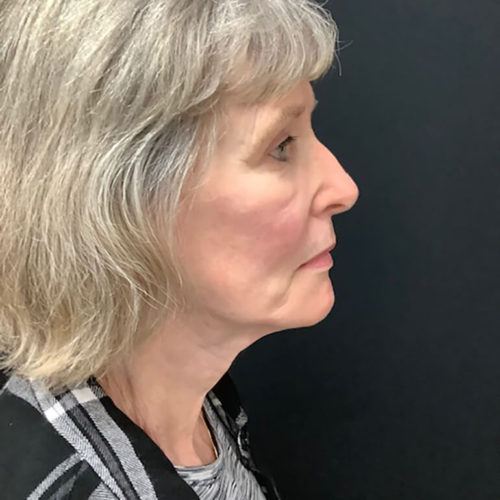 Facelift-21 | After Facelift 3