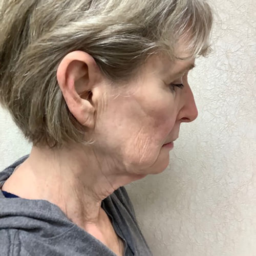 Facelift-21 | Before Facelift 3