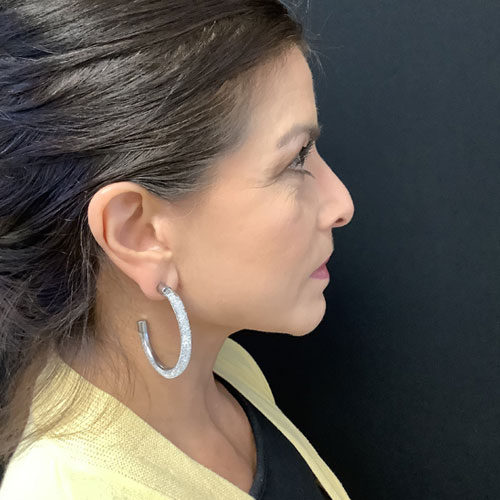 Facelift-22 | After Facelift