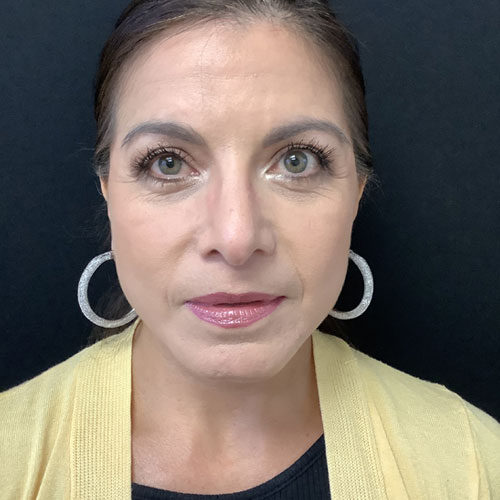 Facelift-22 | After Facelift 2