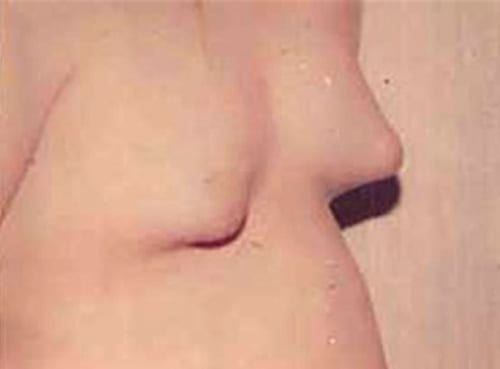 Gynecomastia-01 | Before Gynecomastia