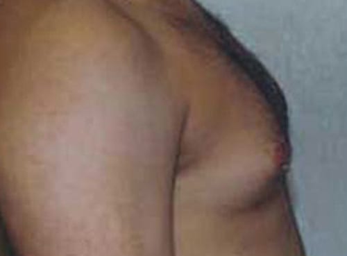 Gynecomastia-02 | Before Gynecomastia