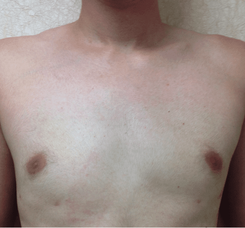 Gynecomastia-03 | After Gynecomastia