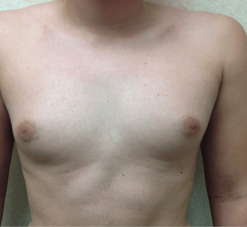 Gynecomastia-03 | Before Gynecomastia