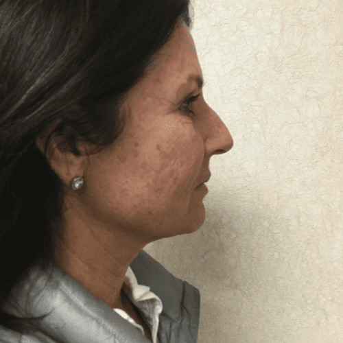 Infini-Laser-01 | After Infini Laser