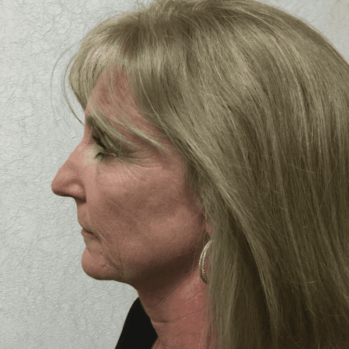 Infini-Laser-02 | After Infini Laser