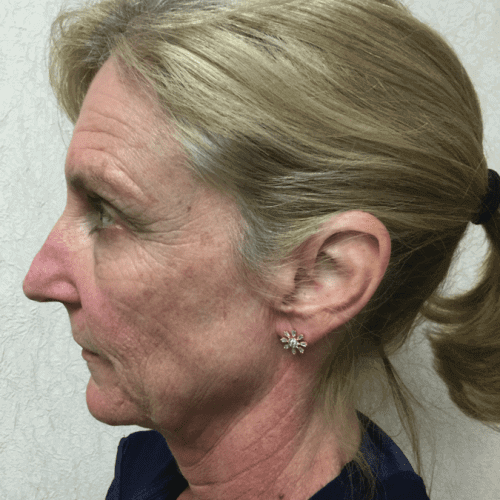 Infini-Laser-02 | Before Infini Laser