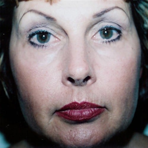 Laser-Resurfacing-01 | After Laser Resurfacing