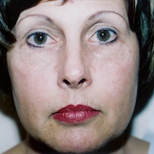 Laser-Resurfacing-01 | Before Laser Resurfacing