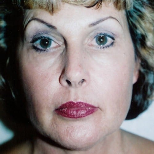 Laser-Resurfacing-01 | After Laser Resurfacing 2