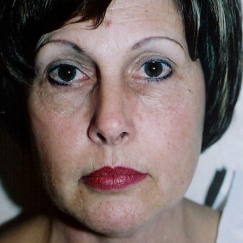 Laser-Resurfacing-01 | Before Laser Resurfacing 2