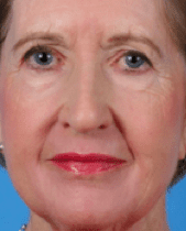 Laser-Resurfacing-02 | After Laser Resurfacing