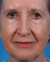 Laser-Resurfacing-02 | Before Laser Resurfacing