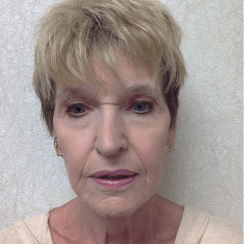 Laser-Resurfacing-03 | After Laser Resurfacing