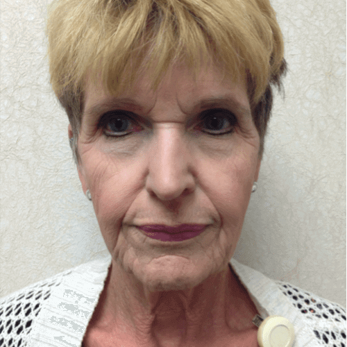 Laser-Resurfacing-03 | Before Laser Resurfacing