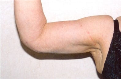 Liposuction-01 | After Liposuction