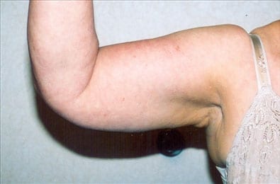 Liposuction-01 | Before Liposuction