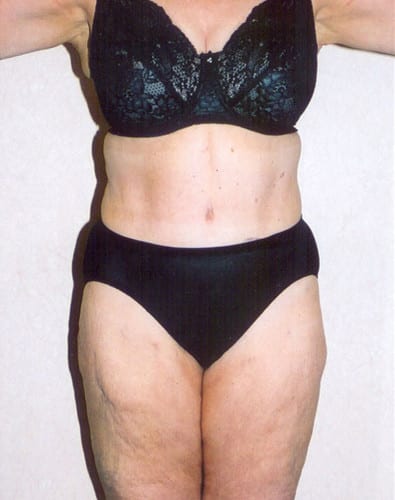 Liposuction-02 | After Liposuction 2