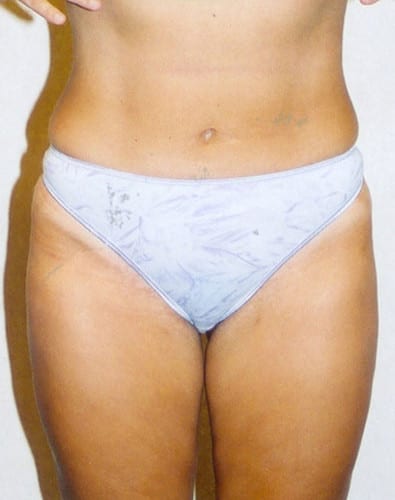 Liposuction-04 | After Liposuction 2