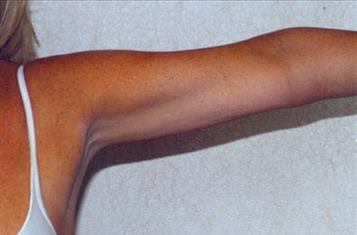 Liposuction-06 | After Liposuction