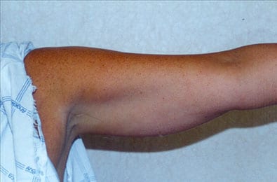 Liposuction-06 | Before Liposuction