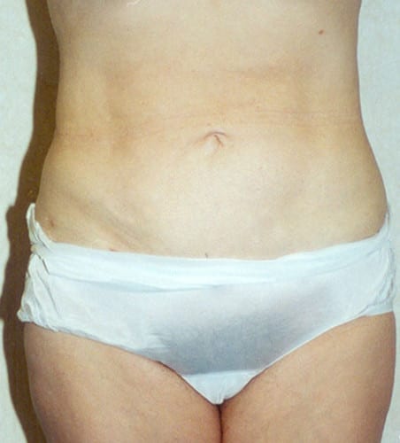 Liposuction-07 | After Liposuction 2