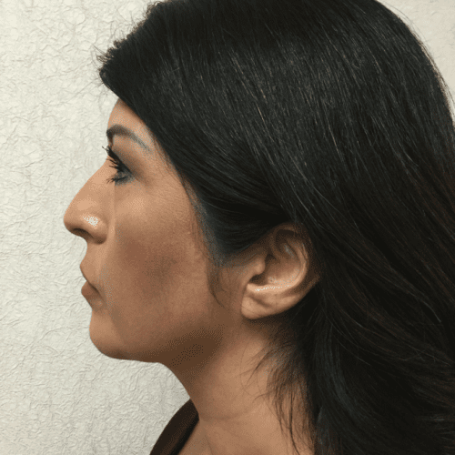 Liposuction-08 | After Liposuction