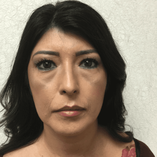 Liposuction-08 | After Liposuction 2